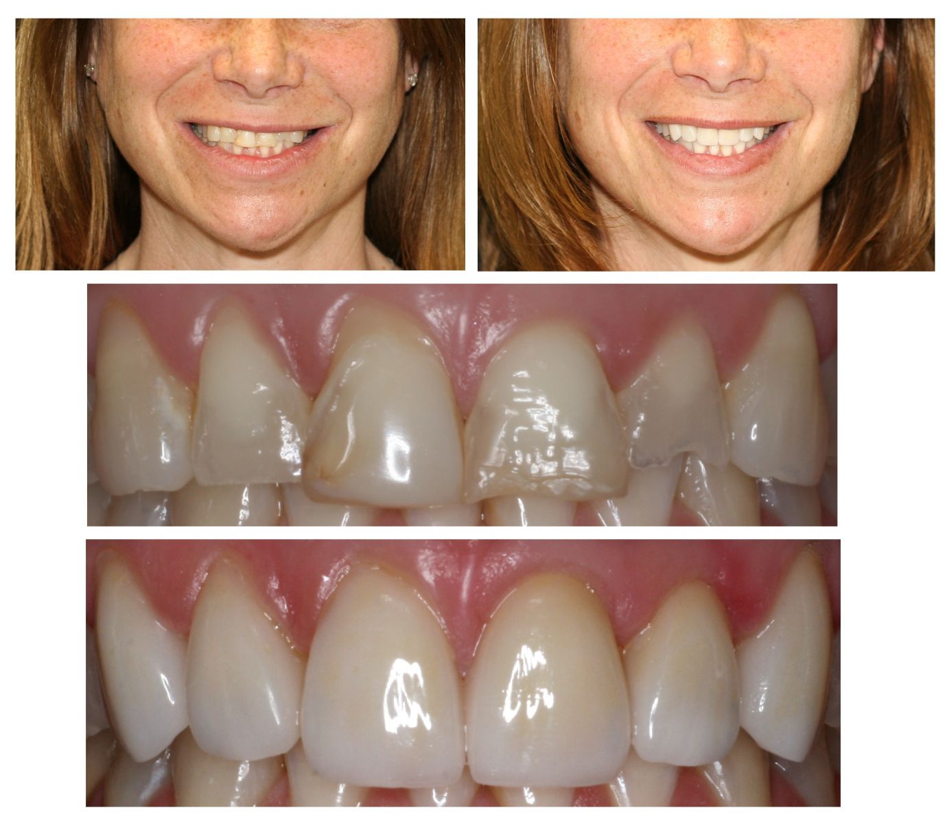 Veneers Douglas Dental Roseville CA